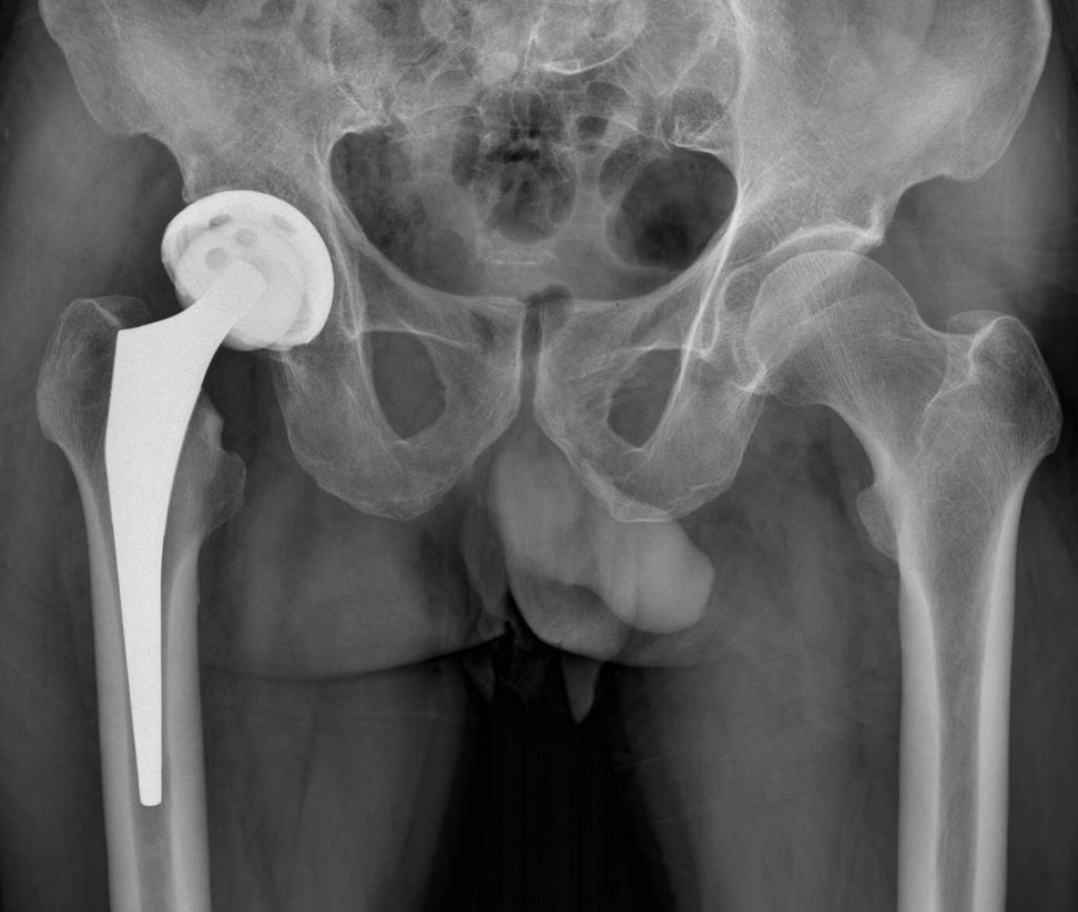 骨頭壞死了還能恢復嗎?——全面解析與康復指南,骨頭壞死能否恢復?全面解析及康復指南