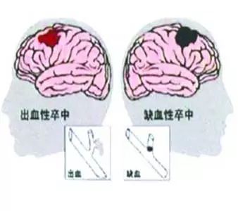 腦中風前兆,識別早期征兆,及時預防與治療,腦中風早期征兆識別與預防治療攻略
