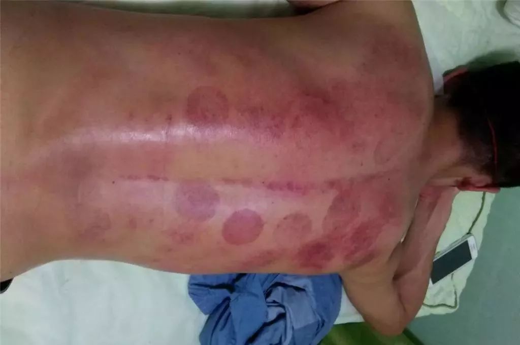 艾灸后如何判斷濕氣排出——一種直觀而實用的方法，艾灸后判斷濕氣排出的實用方法指南