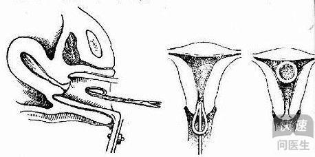 上環后同房激烈是否會有影響?全面解析給您聽,上環后同房激烈對身體的影響,全面解析與注意事項