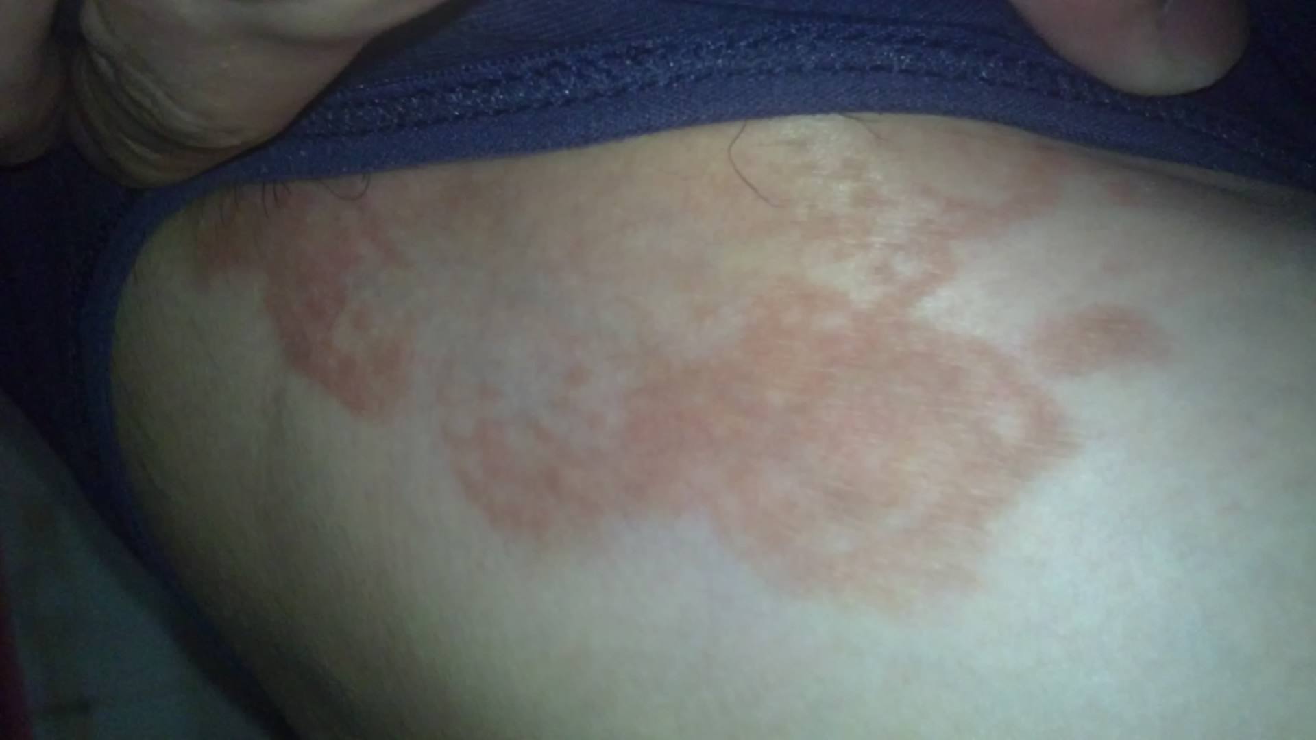 股癬最佳治療藥膏,了解并選擇最適合的藥膏,股癬最佳治療藥膏推薦,選擇最適合的藥膏治療股癬