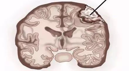 良性腫瘤的三大特征及其影響，良性腫瘤三大特征揭秘，生長、擴散與影響全解析