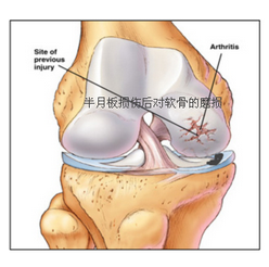 半月板最佳恢復(fù)方法，全方位指導(dǎo)與策略，全方位指導(dǎo)策略，半月板損傷的最佳恢復(fù)方法