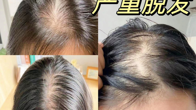 青春期脫發還會再長嗎,原因、治療與頭發再生可能性探討,青春期脫發,再生可能性、原因及治療方法探討