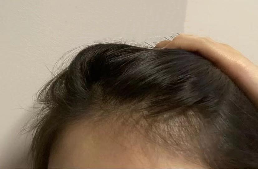 青春期脫發還會再長嗎,原因、治療與頭發再生可能性探討,青春期脫發,再生可能性、原因及治療方法探討