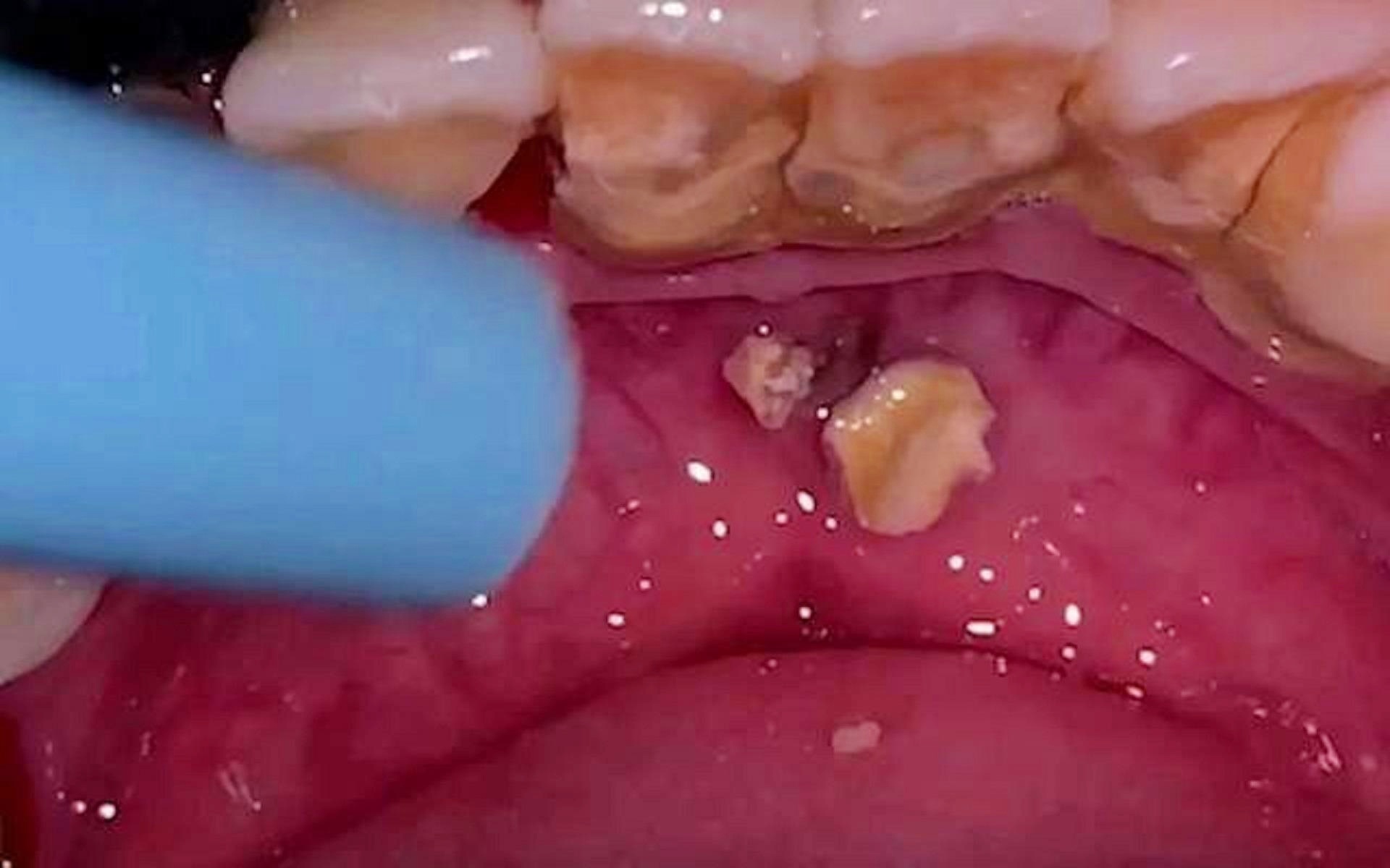 告別牙結石煩惱，5秒脫落牙結石的秘密與真相，揭秘，告別牙結石煩惱，只需5秒輕松脫落的秘密與真相！