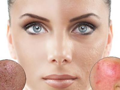 祛痘印小妙招，簡單實(shí)用，告別痘痘痕跡，祛痘印小妙招，告別痘痘痕跡，重拾肌膚光彩