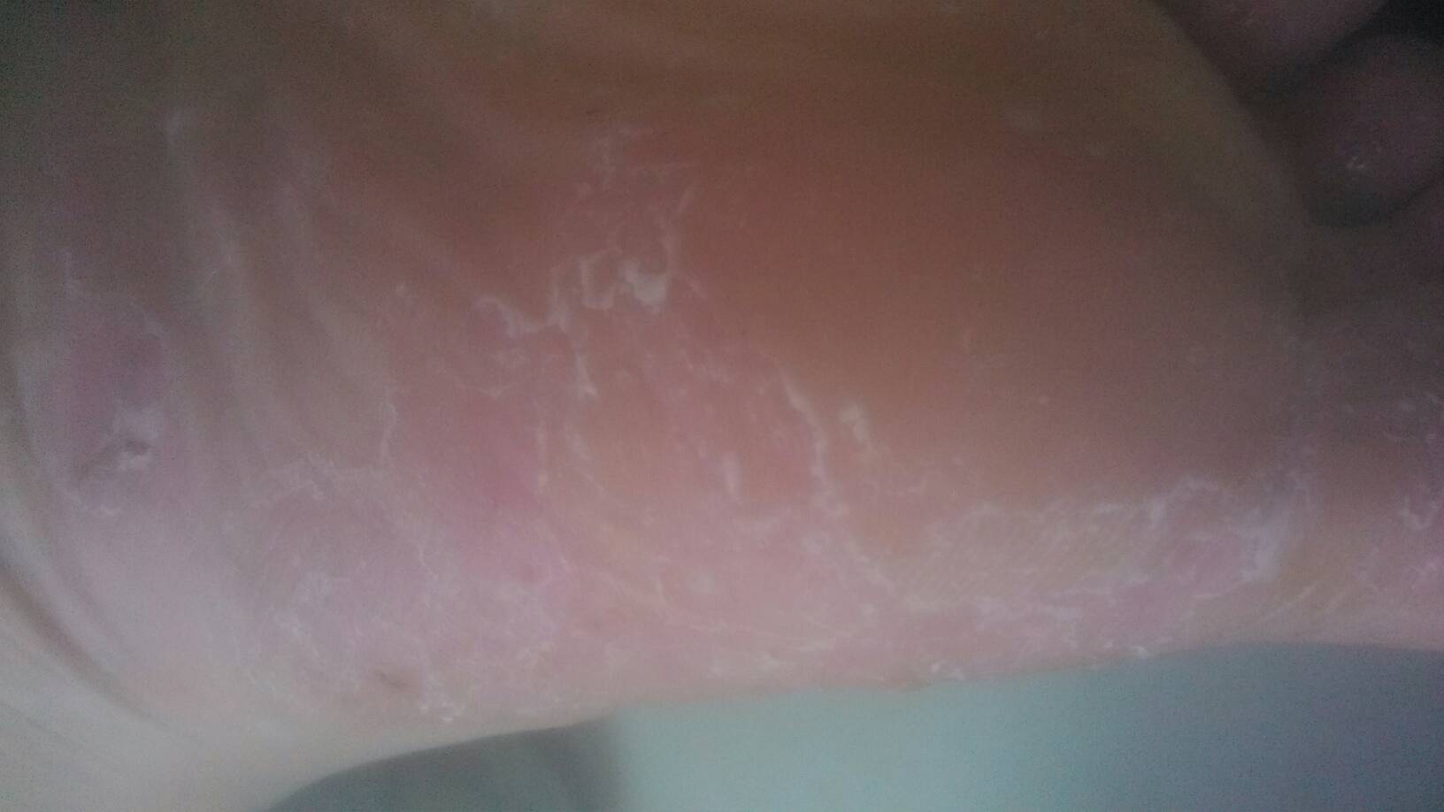 腳癢脫皮起水泡爛腳丫，癥狀解析與最佳用藥指南，腳癢脫皮起水泡爛腳丫，癥狀解析及最佳用藥指南