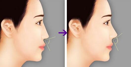 鼻子整容費用咨詢，全面了解鼻子整形手術費用及影響因素，鼻子整容費用全面解析，手術費用及影響因素深入了解