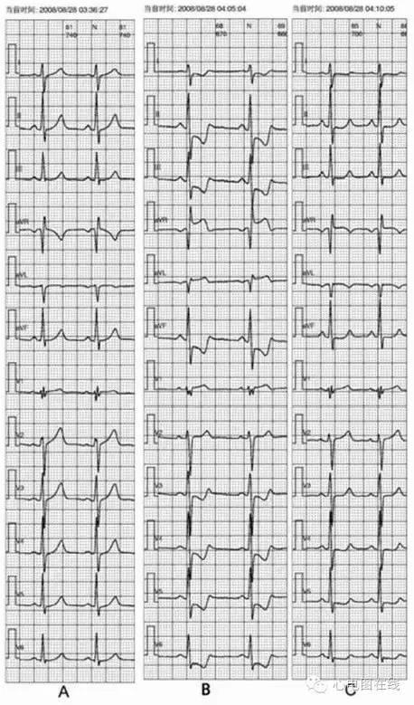 腦供血不足會自愈嗎？解析癥狀、原因及治療方法，腦供血不足詳解，癥狀、成因與治療方法，能否自愈？