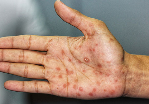 女性一期梅毒疹圖片，了解、識(shí)別與防治，女性一期梅毒疹，圖片識(shí)別、了解及防治攻略