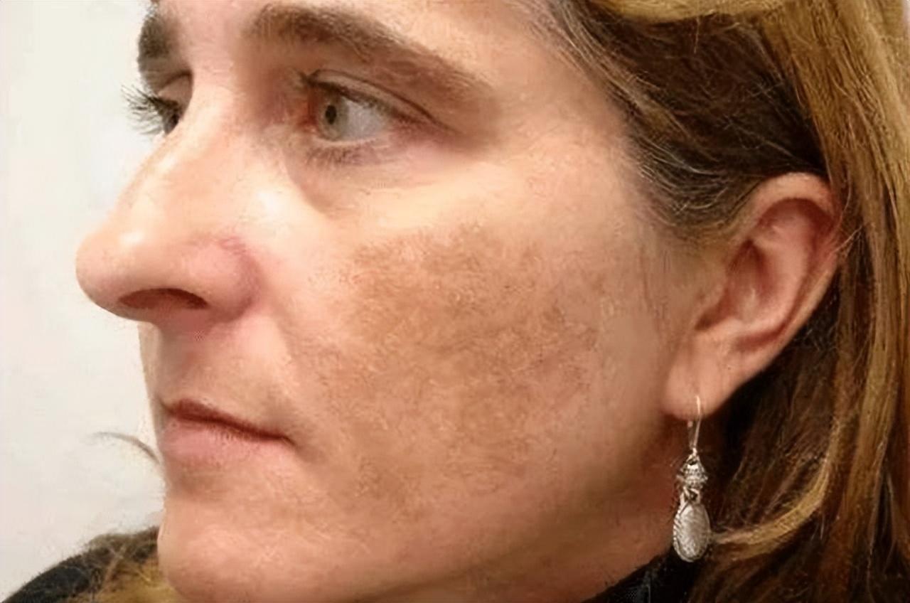 如何有效去除老年斑——全方位指南，全方位指南，如何有效去除老年斑