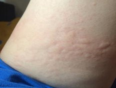 蕁麻疹患者飲食指南，哪些食物不宜食用？，蕁麻疹患者飲食禁忌指南，哪些食物不宜食用？