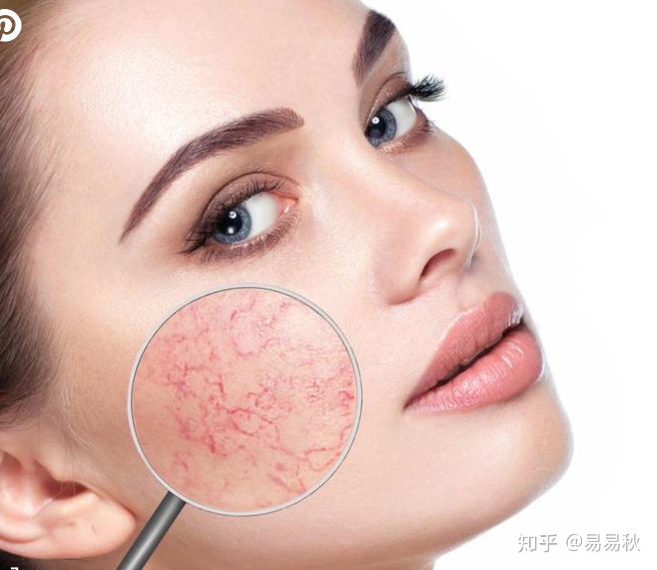 紅血絲的最佳改善方法，紅血絲的最佳改善方法總結與分享