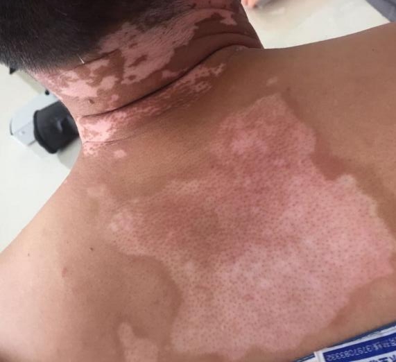 什么樣的白斑不用治——深入了解白斑的多種可能性，白斑的多種可能性解析，哪些白斑無需治療？