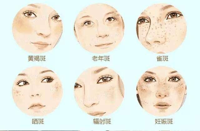 黃褐斑早期圖片，識別、預防與應對，黃褐斑早期識別、預防與應對策略及圖片解析