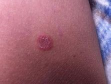 硬下疳，深入了解與應對之道，硬下疳，全面解析與應對策略