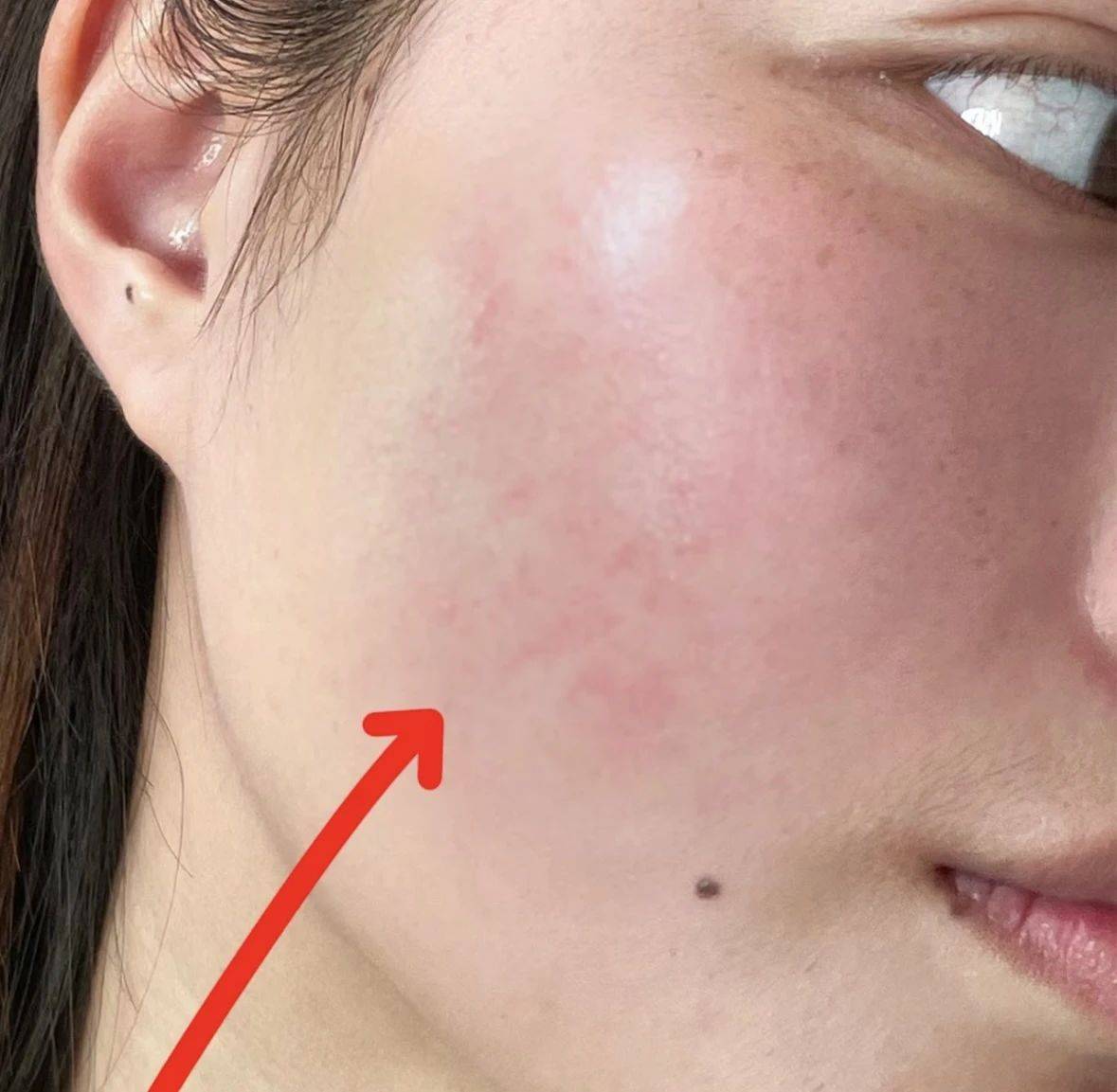 如何有效去除紅血絲，全方位解析與實用建議，全方位解析紅血絲去除方法，實用建議與有效治療策略