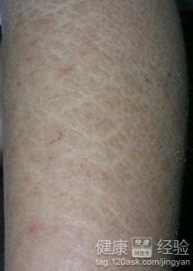 魚鱗皮膚病如何才能根治，全面解析與應對策略，全面解析魚鱗皮膚病根治之道，應對策略大揭秘