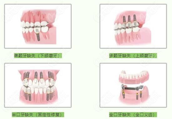種牙多少錢(qián)一顆牙價(jià)格表2023，全面解析種植牙費(fèi)用及影響因素，2023年種植牙價(jià)格表全面解析，費(fèi)用、影響因素一網(wǎng)打盡