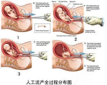 人流半個月后是否可以帶套進行性行為？解析與注意事項，人流半個月后帶套性行為解析及注意事項