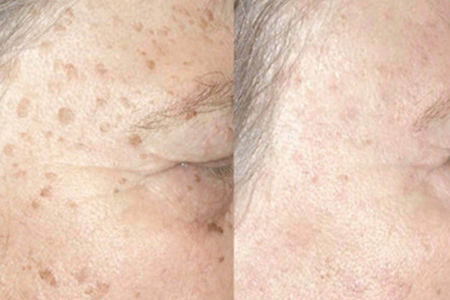 怎樣消除老年斑——全面解析與應對策略，全面解析，消除老年斑的應對策略