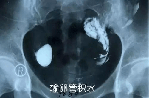 輸卵管造影費用詳解，多少錢及大概價格范圍，輸卵管造影費用解析，價格范圍及詳細費用探討