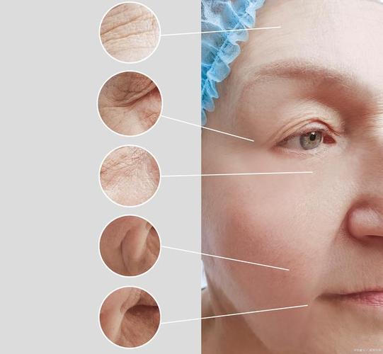 激光去皺紋，效果維持時(shí)間與多重因素解析，激光去皺紋，效果維持時(shí)間與多重因素詳解