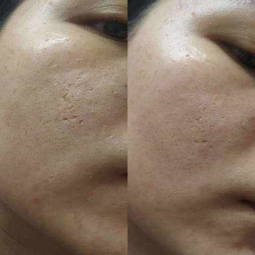 祛痘坑最好的方法，目前最有效的解決方案，最有效的祛痘坑方法，當前最受歡迎的解決方案