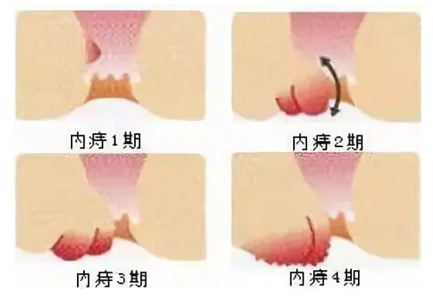 怎樣判斷自己是否患有痔瘡？全面解析與指導(dǎo)，如何判斷自己是否患有痔瘡？詳細(xì)解析及指導(dǎo)指南