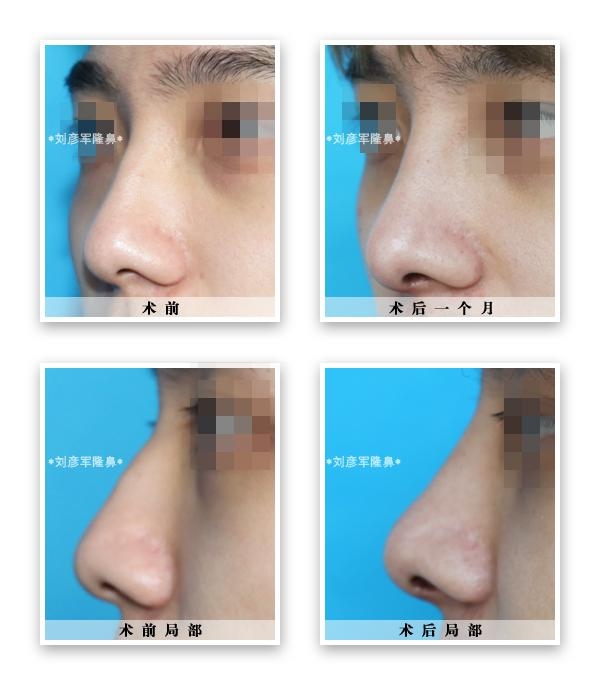 縮鼻頭,改善鼻子外觀的有效方法,縮鼻頭技巧,有效改善鼻子外觀的方法