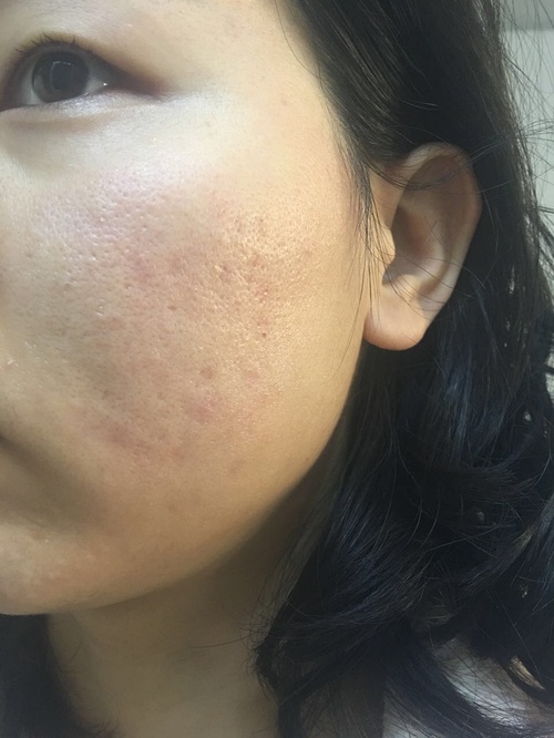 嚴重痤瘡治療最徹底的方法，全面攻略與最佳實踐，全面攻略揭秘，最徹底治療嚴重痤瘡的最佳實踐與最佳方法