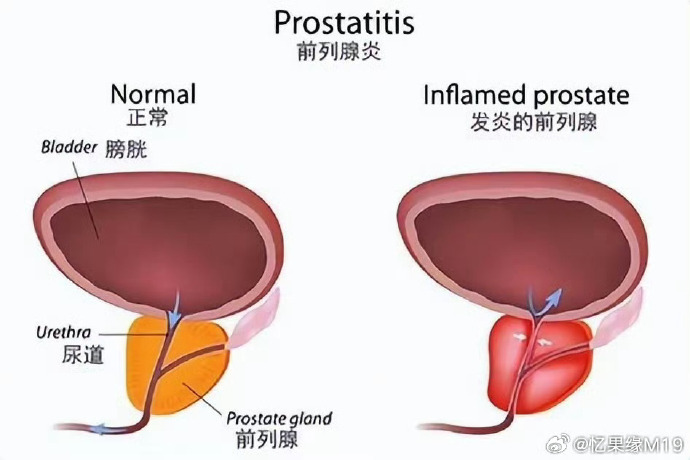 前列腺炎的最佳治療方法探討,前列腺炎最佳治療方法探討與解析
