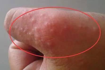 生殖上長小水泡的原因，深度解析與應對建議，生殖部位小水泡成因深度解析及應對建議