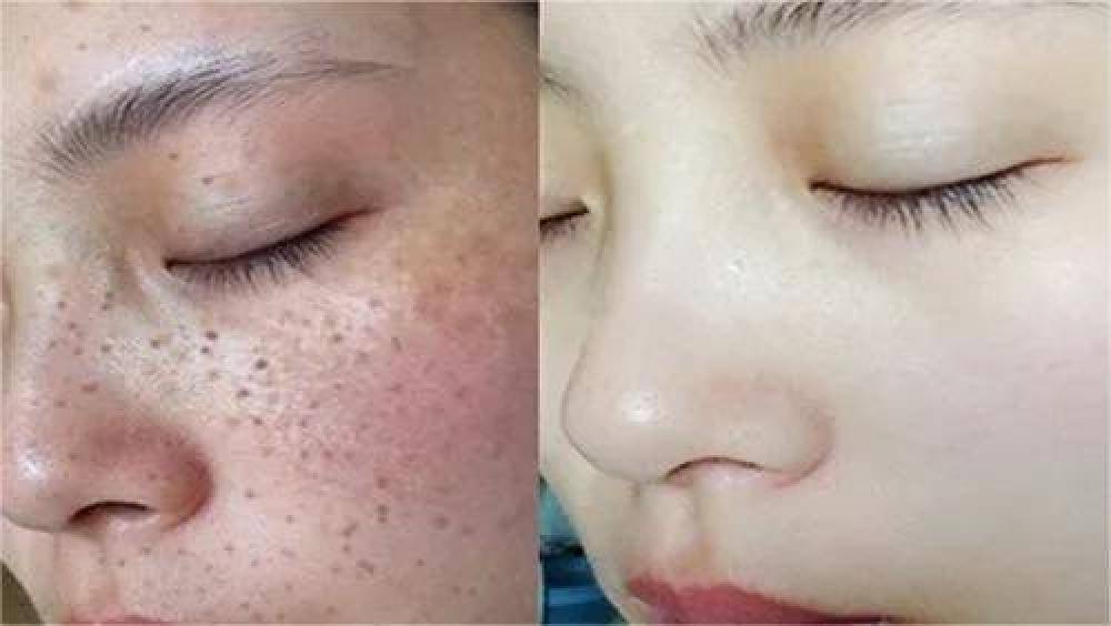 哪種祛斑方法最有效不反彈,全面解析最有效的祛斑途徑,全面解析,最有效的祛斑方法,不反彈之選!