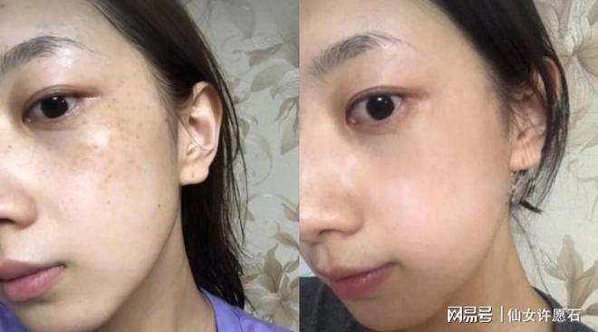 哪種祛斑方法最有效不反彈,全面解析最有效的祛斑途徑,全面解析,最有效的祛斑方法,不反彈之選!