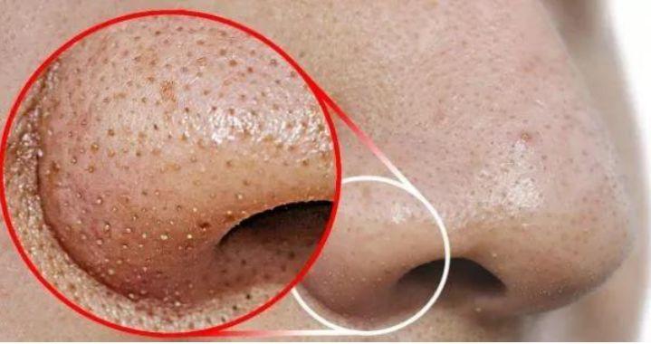 孩子身上起螨蟲疙瘩圖片,了解、預防與治療,孩子身上的螨蟲疙瘩,圖片、預防與治療全攻略