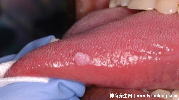 關于HPV感染舌頭初期的圖片及其相關解析，HPV感染舌頭初期癥狀圖片與解析