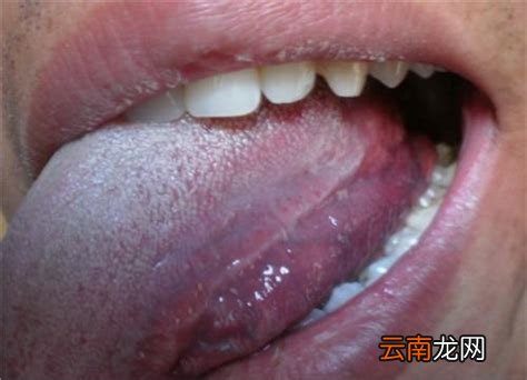 關于HPV感染舌頭初期的圖片及其相關解析,HPV感染舌頭初期癥狀圖片與解析