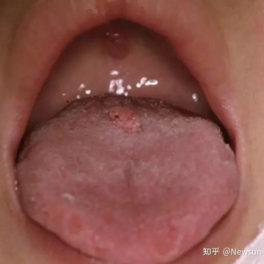關于HPV感染舌頭初期的圖片及其相關解析,HPV感染舌頭初期癥狀圖片與解析
