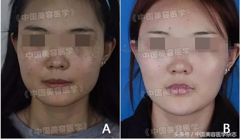 皮秒激光美容,做一次能維持多久?,皮秒激光美容,一次治療,持久維持的美容效果探討