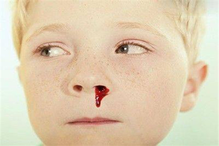 兒童白血病流鼻血的特點及其重要性，兒童白血病流鼻血特征與重要性解析