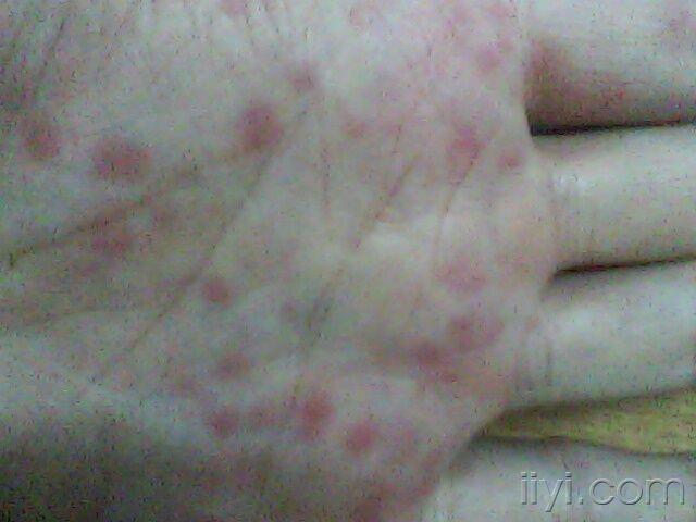 關(guān)于梅毒引發(fā)的紅斑特征及識(shí)別方法，梅毒引發(fā)紅斑的特征與識(shí)別方法指南