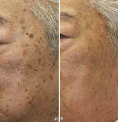 如何有效去除老年斑——全面解析，全面解析，有效去除老年斑的方法