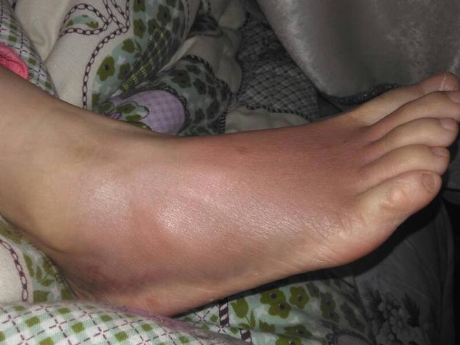 腳腫是什么原因引起的，深度解析腳部腫脹的多元因素，腳部腫脹的深度解析，多元因素引起的腳腫原因探究