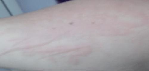 急性過敏性蕁麻疹，全面解析與應(yīng)對(duì)策略，急性過敏性蕁麻疹，全面解析及應(yīng)對(duì)指南