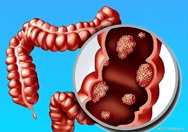 大便形態(tài)變化，細探腸癌征兆，大便形態(tài)變化揭示腸癌征兆