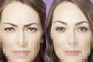 額頭千萬不能打除皺針，了解風險與后果，做出明智選擇，額頭除皺針的風險與后果，明智選擇需了解的內容