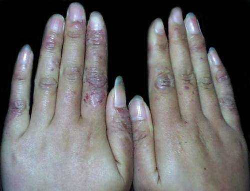 根治凍瘡，預防復發，全面解析凍瘡的治療方法，根治凍瘡，預防復發，全面解析凍瘡治療策略