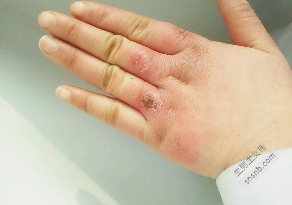 根治凍瘡,預防復發,全面解析凍瘡的治療方法,根治凍瘡,預防復發,全面解析凍瘡治療策略